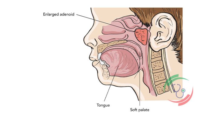 এডিনয়েড